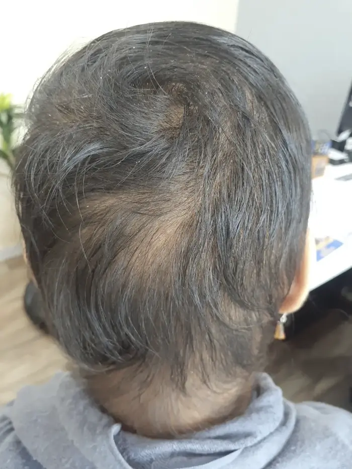 Alopecia Areata case 3 after treatment